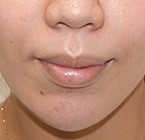 顎プロテーゼ 症例写真-02