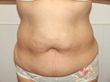 ノーマル脂肪吸引 症例写真-01