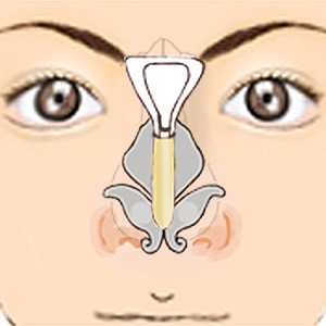 眉間プロテーゼ 眉間ゴアテックス＋鼻筋シリコンを使用