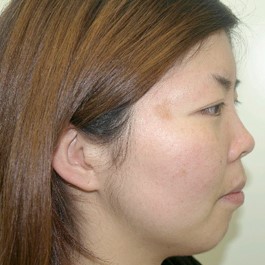 鼻尖形成（耳介軟骨移植） 症例写真-01