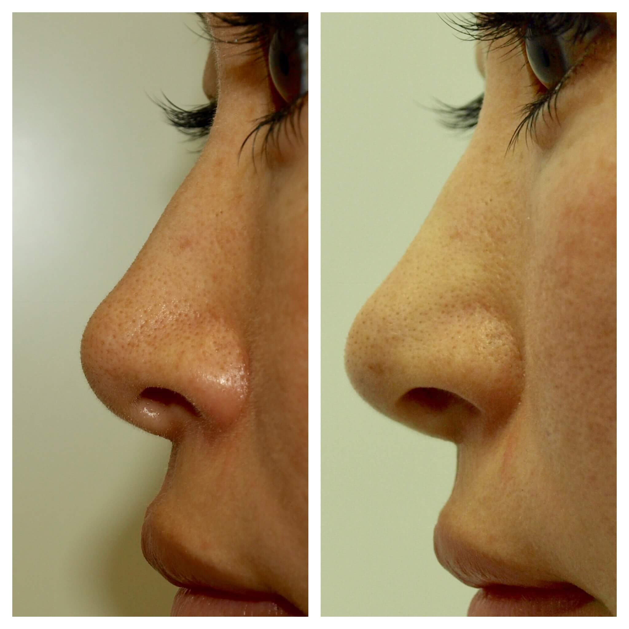 内入路保留鼻整形丨膨体鼻基底+鼻尖塑形 - 知乎
