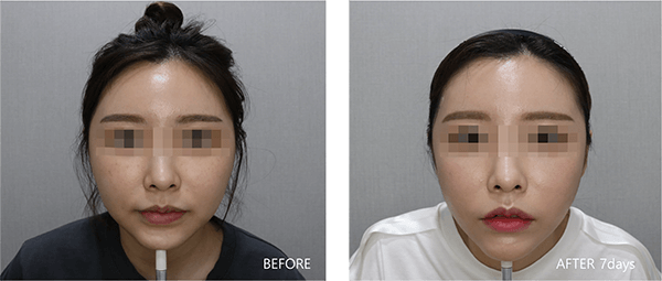 顔面用脂肪溶解注射（BNLS ULTIMATE） 症例写真-02