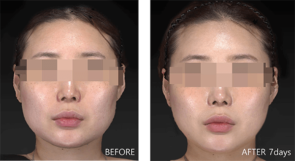 顔面用脂肪溶解注射（BNLS ULTIMATE） 症例写真-05