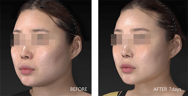 顔面用脂肪溶解注射（BNLS ULTIMATE） 症例写真-06