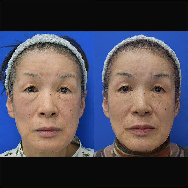 ハムラ法 症例写真 6