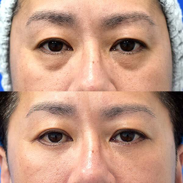 ハムラ法 症例写真-07