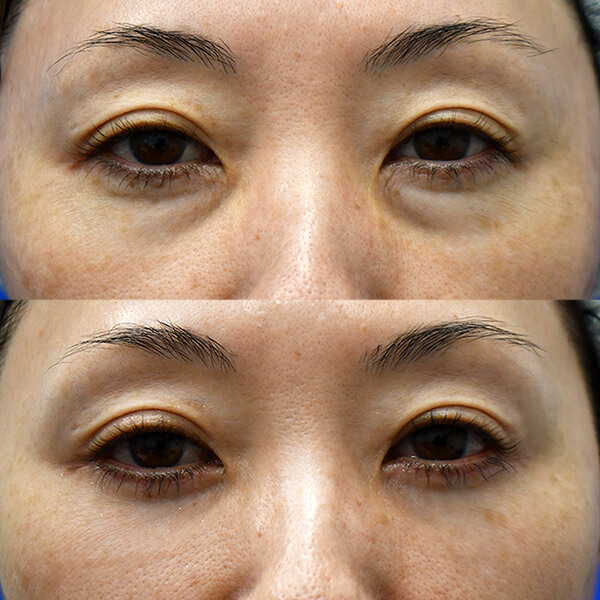 ハムラ法 症例写真 8