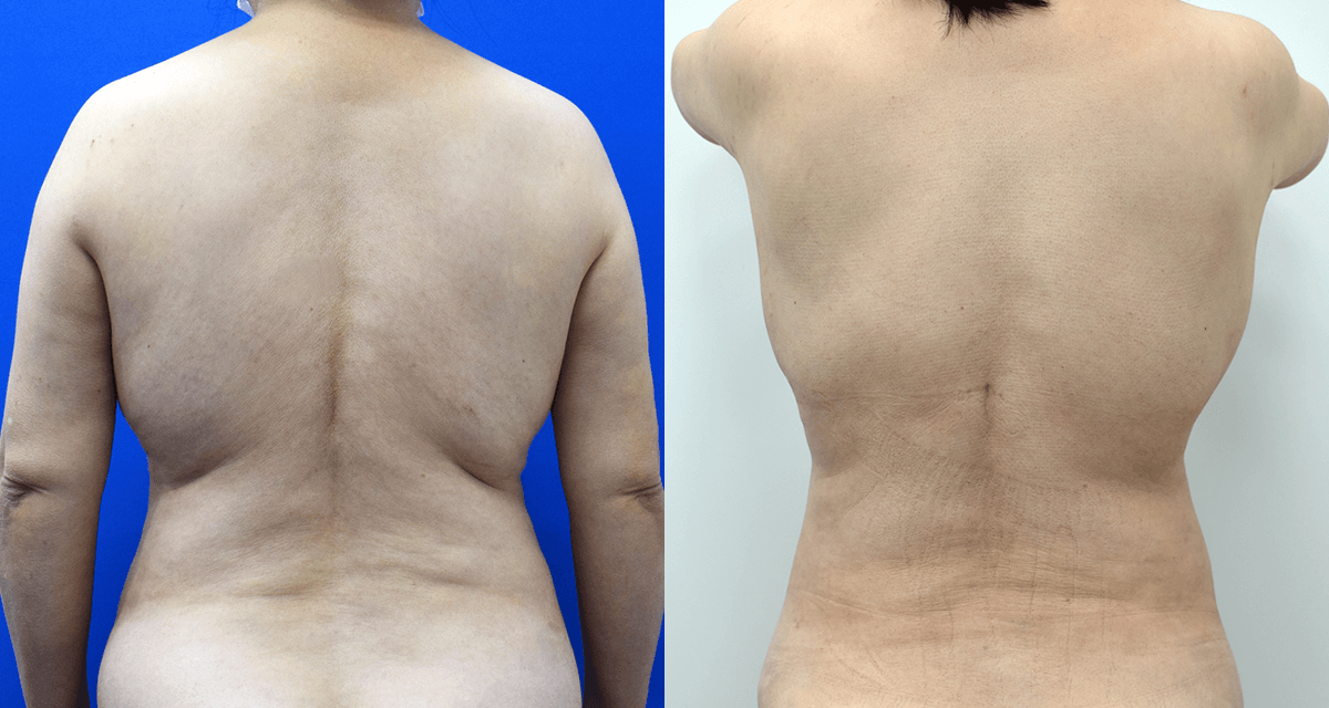 ベイザー 脂肪吸引 症例写真 上腹部・側腹部・後腋窩・背中上下・腰部01