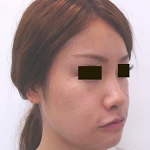 隆鼻術 症例写真-09