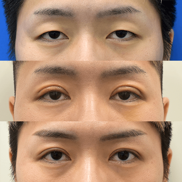 眼瞼下垂 症例写真 3