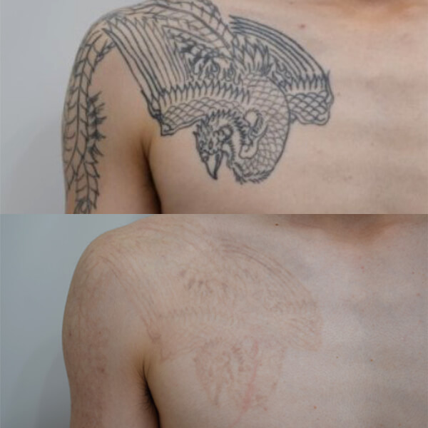 タトゥー・刺青 症例写真-07