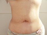 ノーマル脂肪吸引 症例写真-02