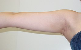 ベイザーリポ2.2 脂肪吸引 症例写真 腕03