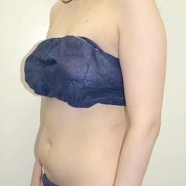 ベイザー 脂肪吸引 症例写真 腹部14
