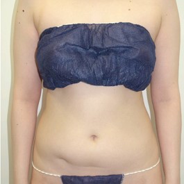 ベイザー 脂肪吸引 症例写真 腹部17