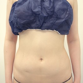 ベイザー 脂肪吸引 症例写真 腹部18