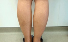 ベイザー 脂肪吸引 症例写真 下腿01