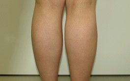 ベイザー 脂肪吸引 症例写真 下腿02