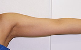 ベイザーリポ2.2 脂肪吸引 症例写真 腕11