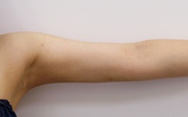 ベイザーリポ2.2 脂肪吸引 症例写真 腕12