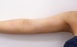 ベイザーリポ2.2 脂肪吸引 症例写真 腕14