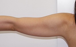ベイザーリポ2.2 脂肪吸引 症例写真 腕31