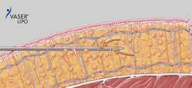 遊離された脂肪細胞は、刃の無い吸引カニューレで容易に除去