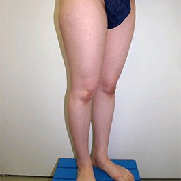 ベイザー 脂肪吸引 症例写真 脚0