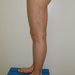 ベイザー 脂肪吸引 症例写真 脚12
