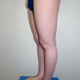 ベイザー 脂肪吸引 症例写真 脚19