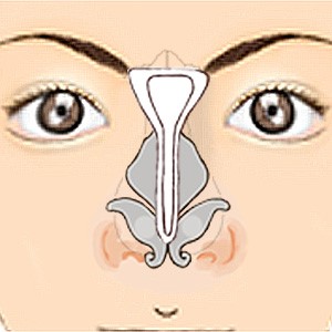 眉間プロテーゼ 眉間＋鼻筋ゴアテックスを使用