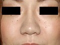 鼻ヒアルロン酸注入 症例写真-02