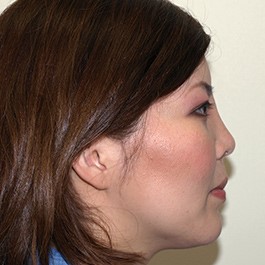 鼻尖形成（耳介軟骨移植） 症例写真-02