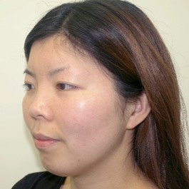 鼻尖形成（耳介軟骨移植） 症例写真-03