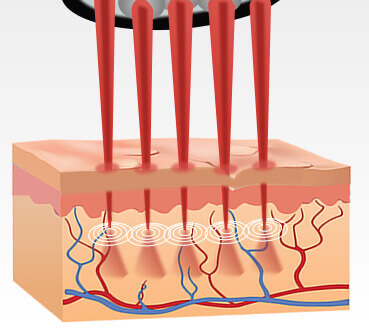 肌の再生・入替をするマイクロスポット照射