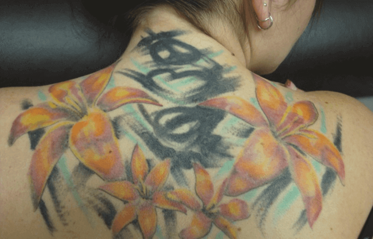 タトゥー・刺青 症例写真-05